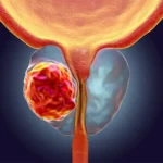 Рак простати