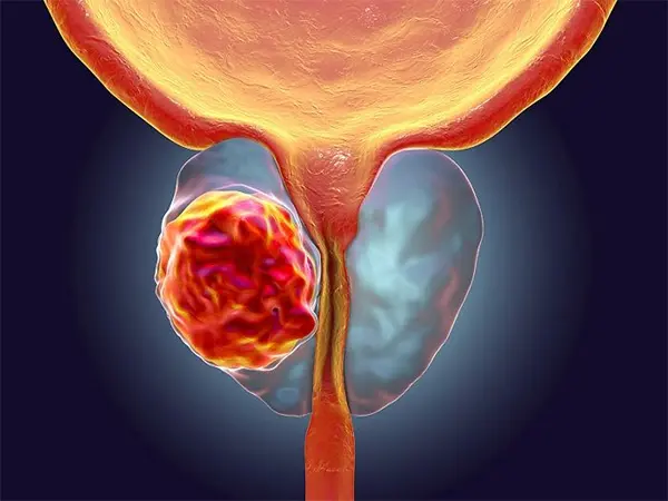 Рак простати