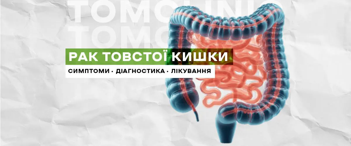 Рак товстої кишки: симптоми, діагностика та лікування
